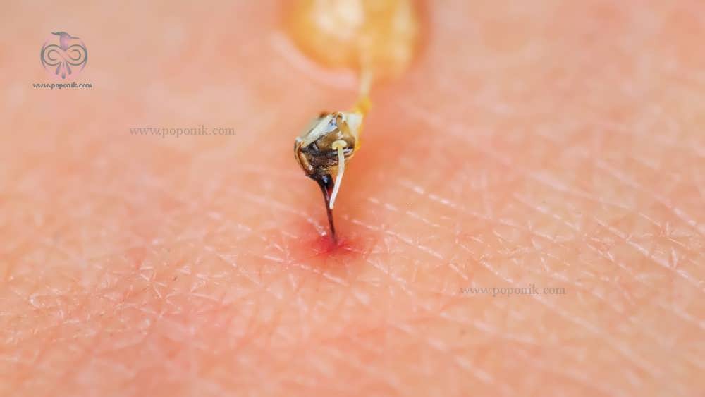نیش تیز زنبور عسل با سم شکسته شده آن که بر روی پوست جا گذاشته